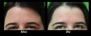 Results of Laser Treatment | Acne Scar Improvement in Patient