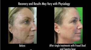 Los Angeles patient before and after laser rejuvenation with Fraxel and Spectra