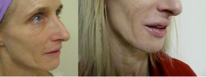  Los Angeles patient before and after her lip augmentation procedure with Juvederm