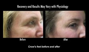 Botox Pictures of Los Angeles Patient's Results| Crows Feet Reduction