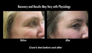 Botox Results| Getting Rid of Crows Feet - Los Angeles Patient