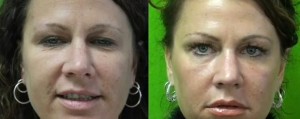 Before and After 2 Fraxel Dual Age Spot Treatment in Los Angeles 