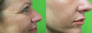 Results of Lip Augmentation 