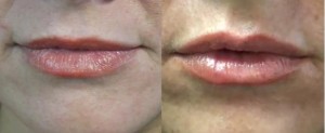 Lip Augmentation Before and After in Los Angeles