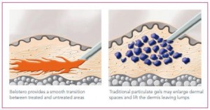 image courtesy of Merzpharma.co.uk The difference between Belotero and comparative dermal fillers