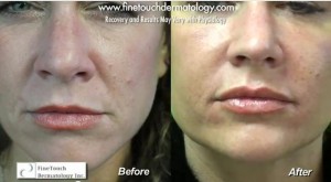 Results showing injection of Radiesse in the nasolabial folds