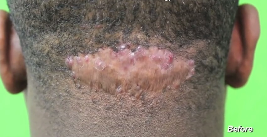 Patient's Acne Keloidalis Nuchae Scar Before His Surgery