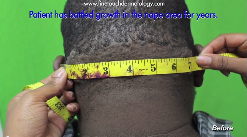 Patient With Long Acne Keloidalis Nuchae Tumor