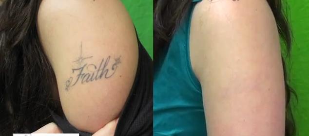 ... said that her laser tattoo removal process “wasn’t that painful