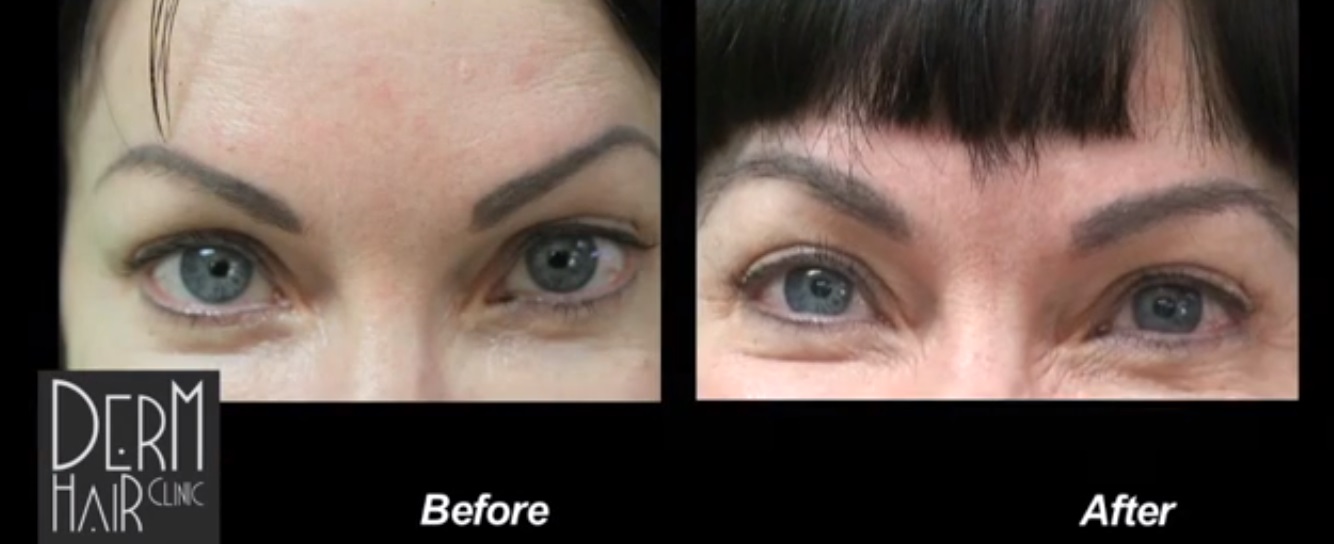 Eyebrow transplantation results