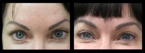 Eyebrow Transplant| UGraft and Nape Hair