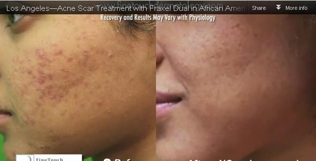 los-angeles-fraxel-results-34 Los Angeles patient experienced noticeable Fraxel results for her acne scars. This improvement was also validated quantitatively through a VISIA skin analysis