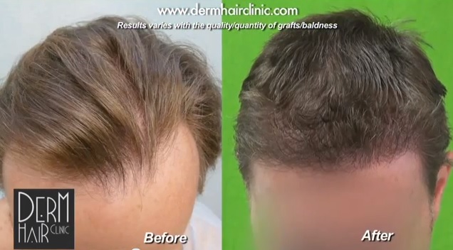 Los Angeles best FUE hair transplant