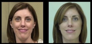 Los Angeles Juvederm results for laugh lines-before and after