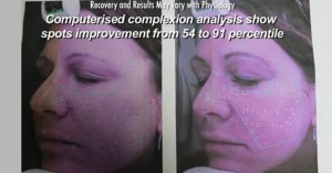 Los Angeles patient who experienced real improvements in her complexion that were verified through a VISIA skin analysis