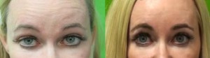 Los Angeles patient with a wrinkle free forehead after her Botox treatment