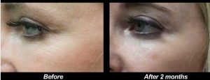Before and after pictures of crows feet treatment with Botox