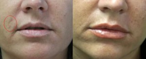 Los Angeles patient who underwent Fraxel Dual for age spot removal-before and after pictures