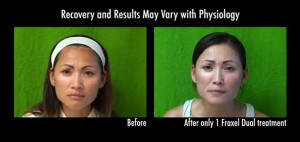 Fraxel doctor used Fraxel Dual to remove age spots on this Los Angeles patient