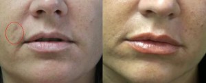 Patient of Los Angeles Fraxel doctor who got rid of age spots using Fraxel Dual