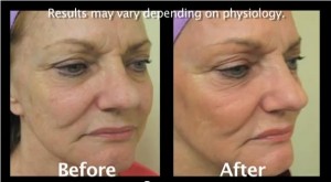 Before and after patient of Los Angeles Fraxel doctor who received Fraxel Repair
