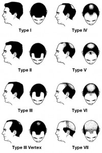 Norwood scale showing the stages of male pattern baldness.