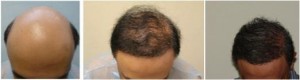 Results of FUE hair transplant surgery in two sessions.