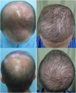 Los Angeles hair transplant cost- Patient before and after his FUE procedure