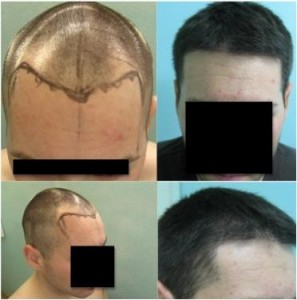 Los Angeles Hair Transplant Cost