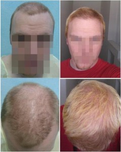 Before and after pictures of patient's procedure which restored normal hair density on top of his head