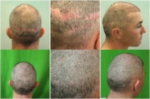 Strip scars left this patient with very minimal head donor hair. However coverage and great cosmetic results were achieved using body hair transplant methods