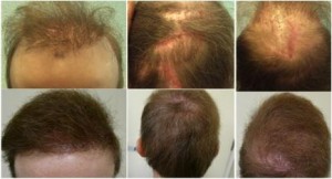 Patient whose life changed for the better after FUE hair transplant gave excellent coverage for scars