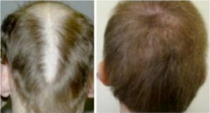 Patient of Derm Hair Clinic in Los Angeles before and after hair transplant repair