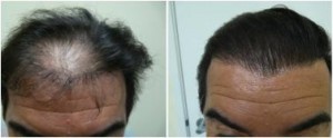 2050 graft hair transplant repair performed with uGraft