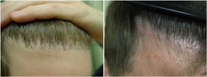 Los Angeles hair transplant repair procedure corrects doll's hair plugs