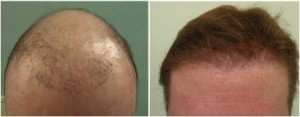 hair transplant repair procedure with donor follicles extracted from the body