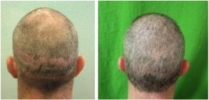 Successful hair transplant repair that covered up strip scars