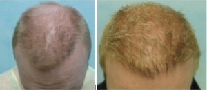 Assymetrical hairline was fixed with hair transplant repair