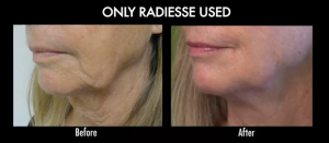 Patient with jowls before and after her Radiesse treatment