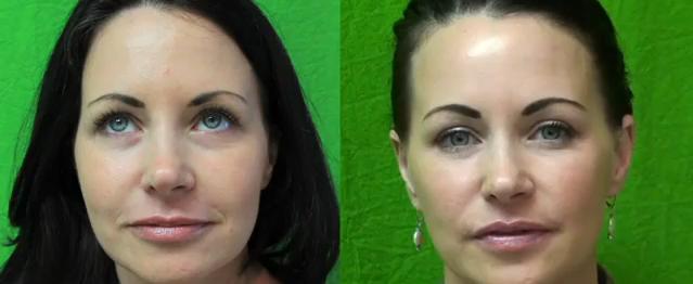 los-angeles-non-surgical-face-lift-01 Los Angeles patient who received the effects of a non-surgical face lift with Radiesse administered in the nasolabial folds