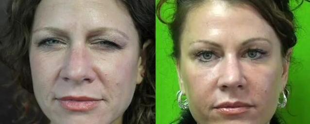 los-angeles-non-surgical-face-lift-02 A Los Angeles woman who also experienced a non-surgical face lift with the use of Radiesse applied to the nasolabial folds