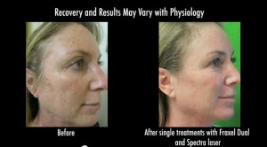 los-angeles-skin-laser-01 Los Angeles patient before and after skin laser treatments with Fraxel Dual and Spectra