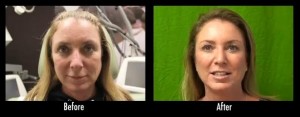 Before and after pictures of Los Angeles patient who experienced positive before and after results from using Botox to treat wrinkles.