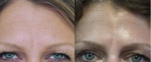 Los Angeles patient showing excellent results from using Dysport on the frown lines for wrinkle treatment
