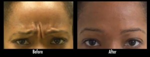  Wrinkle treatment results of frown lines on Los Angeles patient