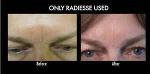Patient with frown line between her brows was treated with Radiesse