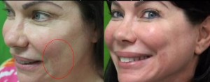 Before and After of Belotero get Rid of Fine Lines