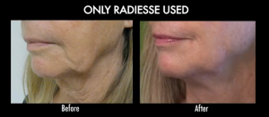 Los Angeles jowls treatment- patient before and after her jowls treatment with Radiesse