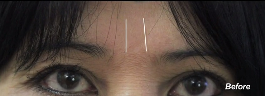 Patient Before Her Frown Line Treatment Procedure