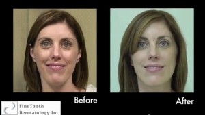 Los Angeles Juvederm Info- Mild forms of laugh lines can benefit from HA fillers like Juvederm